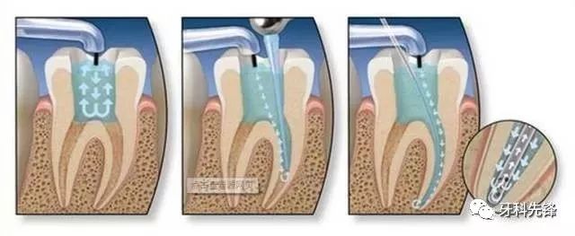 牙齿戴冠还会劈裂,戴冠后牙会不会劈裂
