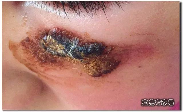 小孩脸上摔了口子能缝针吗,小孩脸摔破皮结痂后可以抹芦荟吗