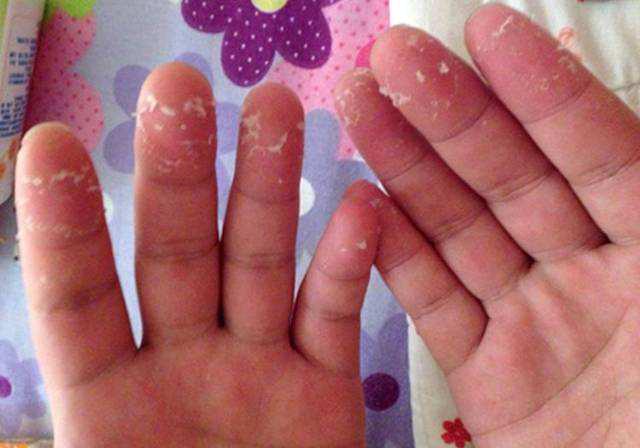 孩子手老是反复脱皮,小孩老是手脱皮什么引起的