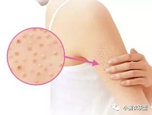 毛囊根部有凸起像鸡皮疙瘩痒,大腿毛囊有粉刺一样的疙瘩