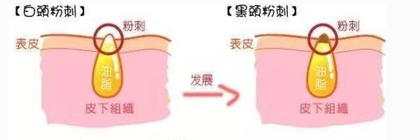 你知道什么是闭口吗,闭口和不是闭口