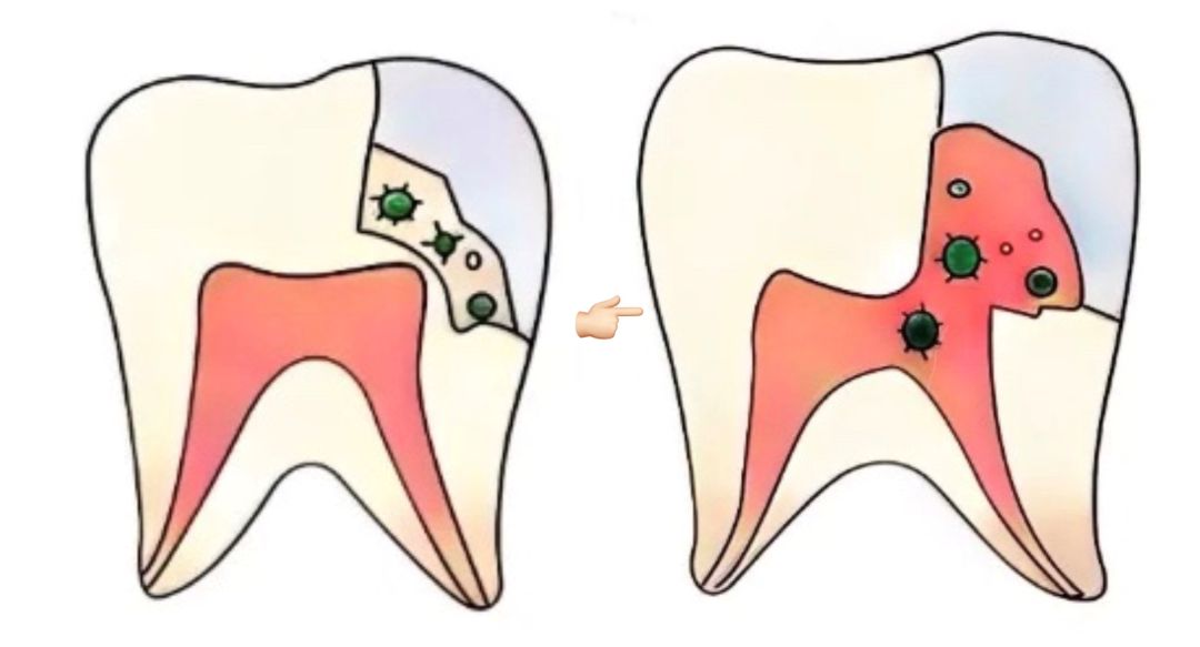 补个牙洞后为什么会出脓,补个牙医生把虎牙磨平了