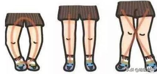 宝宝腿不直长大了能变直吗,宝宝腿不直正常吗需要干预吗