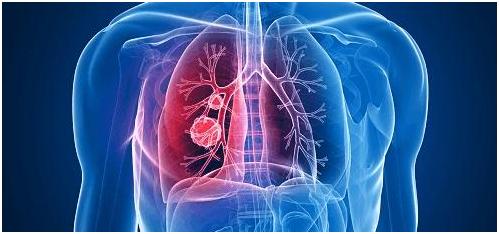 肺癌大病理和小病理区别,肺癌病理学分类2021