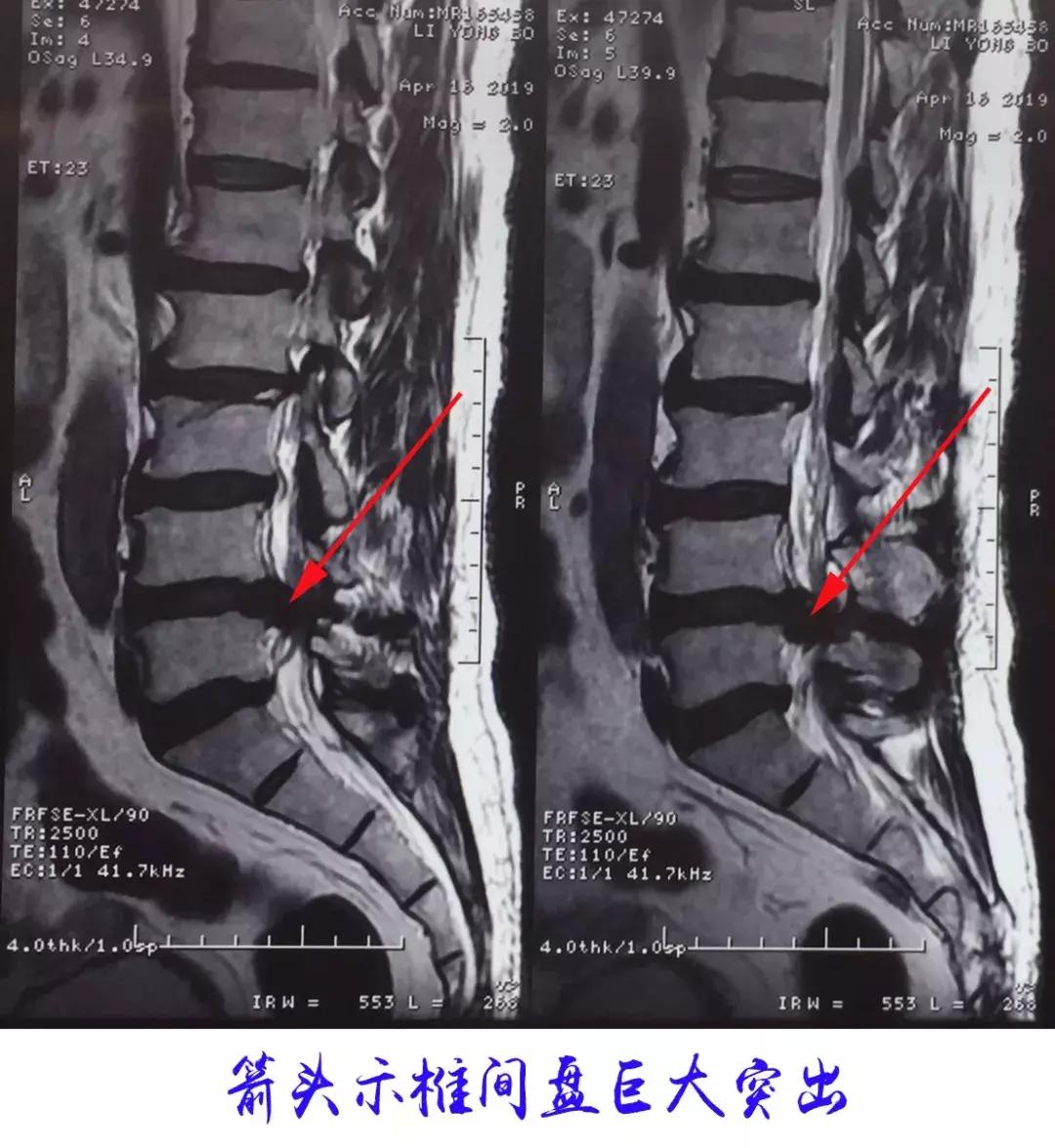什么人适合微创手术治疗腰突,可视放射性治疗腰突效果怎么样