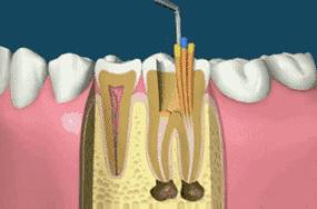 补过的牙几年后胀,刚补了牙该注意什么