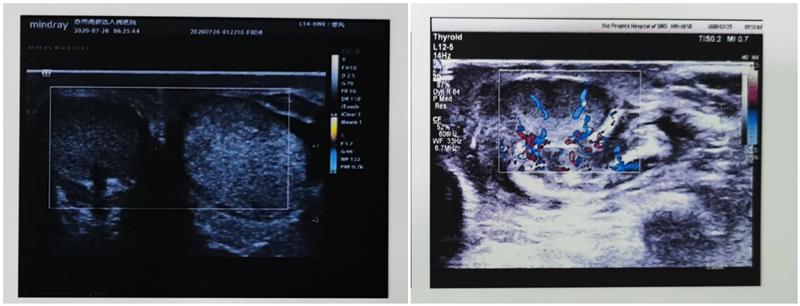 睾丸偶发性疼痛需要切除吗,儿子突然蛋蛋有点疼怎么治疗