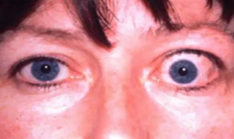 眼睛大是什么综合症,眼睛大是什么病征兆