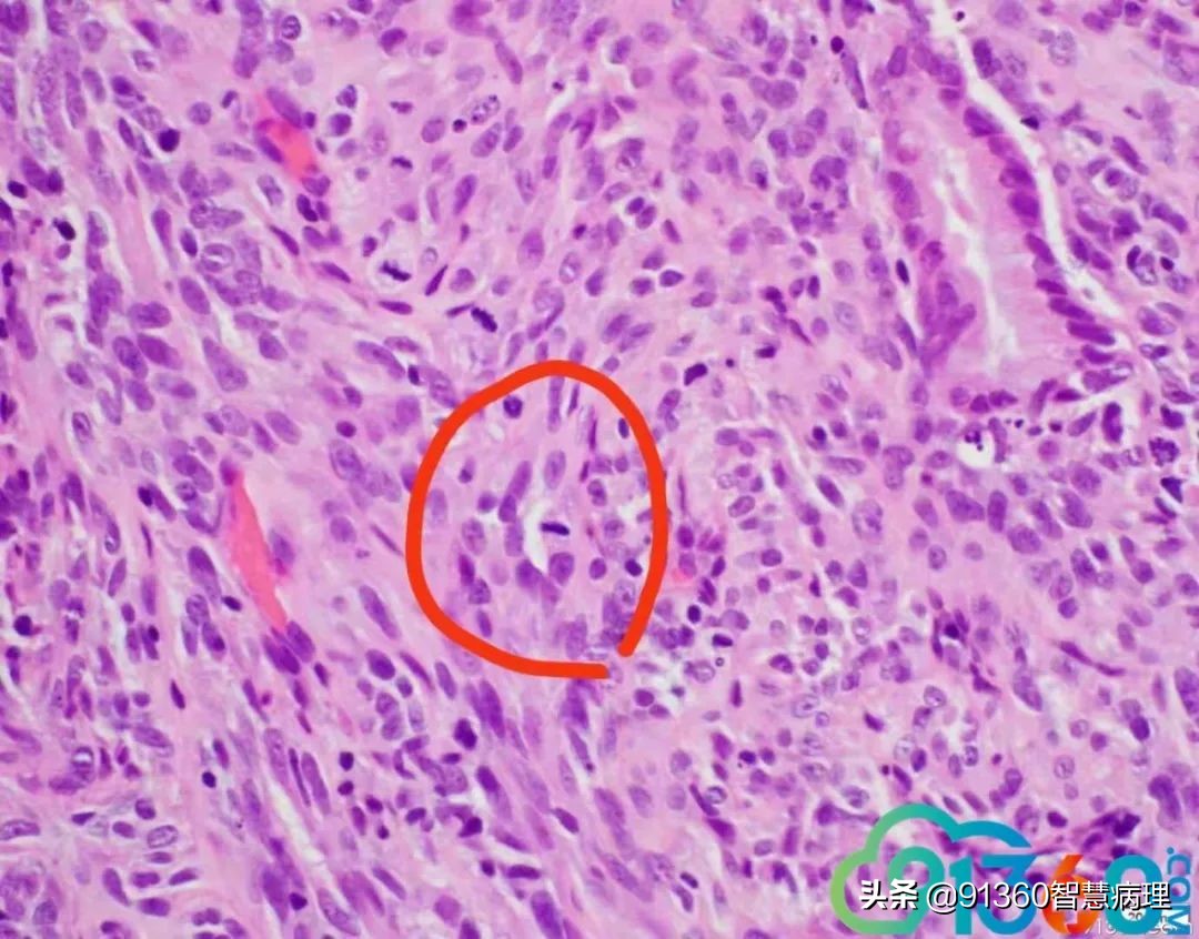 宫颈腺癌silvaa型用化疗吗,宫颈腺癌silvab型需要放疗几次