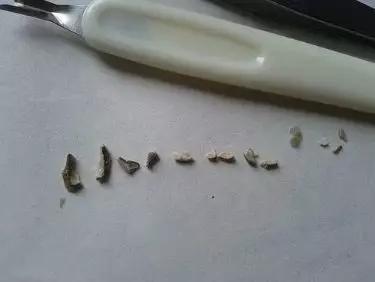 自己抠下来一块牙结石,自己动手抠牙结石