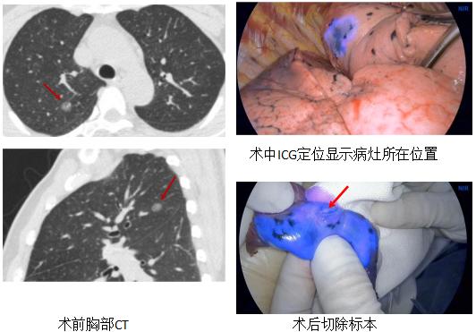 小细胞肺癌的气管镜介入治疗,导航支气管镜在肺癌诊断中的应用