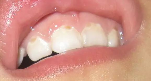 小孩得了奶瓶龋该怎么治疗,宝宝牙齿奶瓶龋怎样治