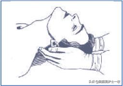 干货：气管切开术及护理措施