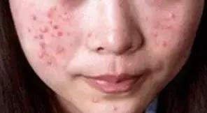 熬夜追《知否》后脸上狂暴痘？这些德国产品可以拯救你的脸！