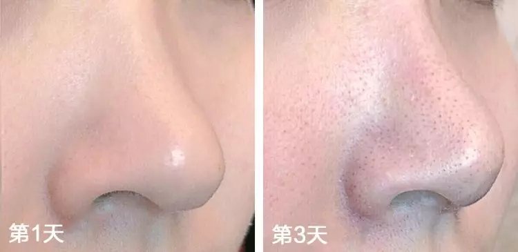 去黑头的方法一天就能把黑头去掉,怎么根治黑头的小妙招