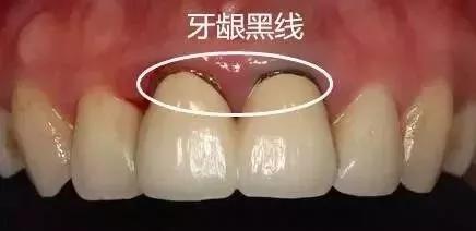 口腔假牙以旧换新活动,镶牙活动假牙