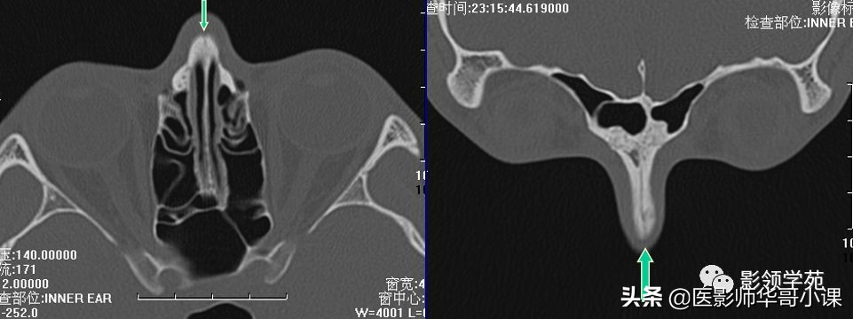 「鼻骨彩图」鼻骨CT解剖及骨折影像学诊断