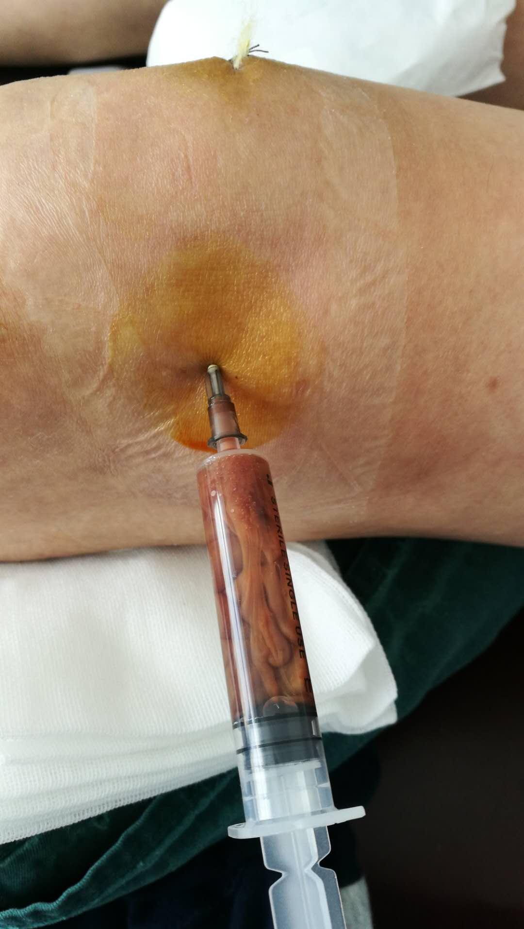 膝盖积水以后是热敷还是冷敷？真能解决问题吗？医生：可能都没用