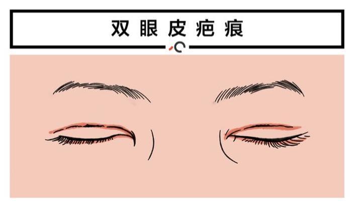 全切双眼皮术后护理注意事项,全切双眼皮术后护理方法