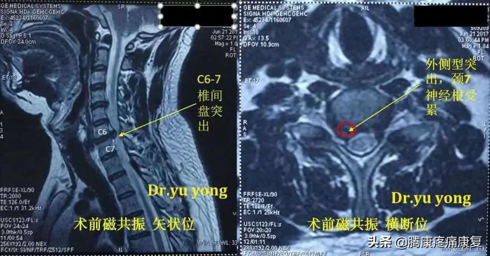 颈丛神经卡压症推拿手法,颈神经卡压的症状是什么