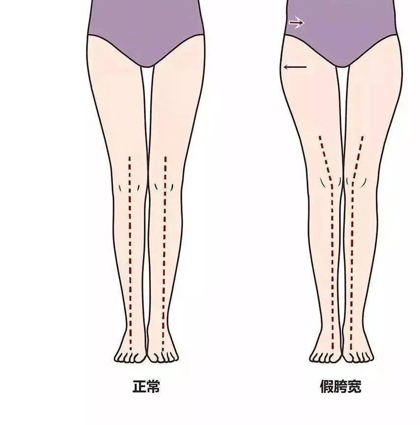 假胯宽翘臀矫正的正确方法,臀腿假胯宽训练