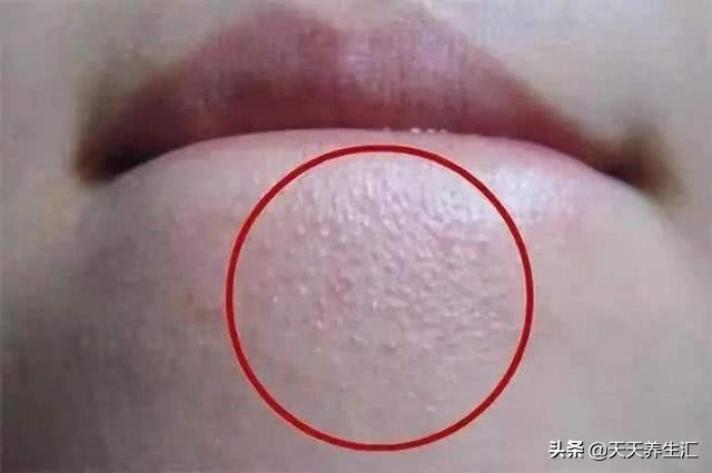 下巴有白色颗粒怎么解决,下巴有白色颗粒凸起是什么原因
