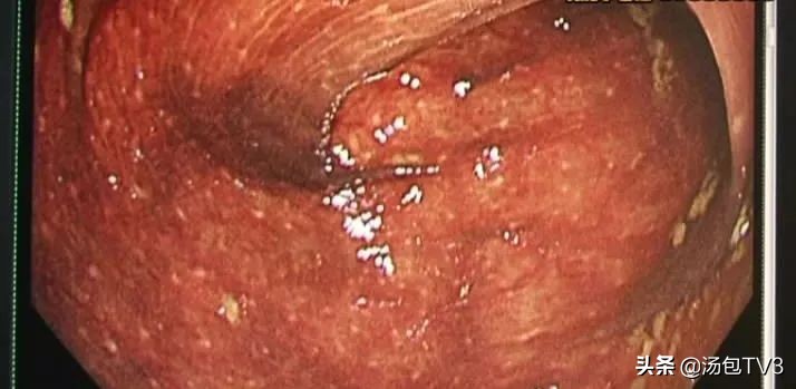 芦荟会使肠道变黑吗,吃芦荟胶囊肠道变黑能恢复吗