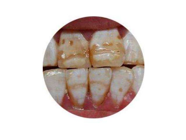 牙龈出血牙齿疏松怎么治疗,牙龈出血发黑是怎么解决