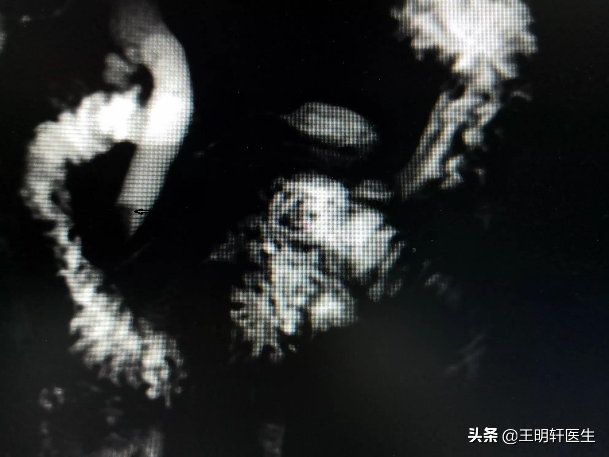 黄疸的分类及鉴别诊断要点,黄疸分类及特点