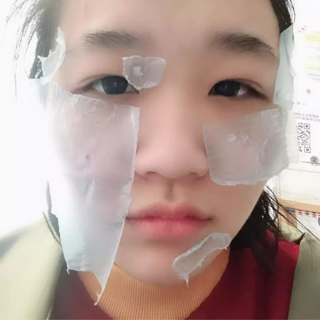 激光祛痣怎么好得快不留疤,激光祛痣亲身经历和感受