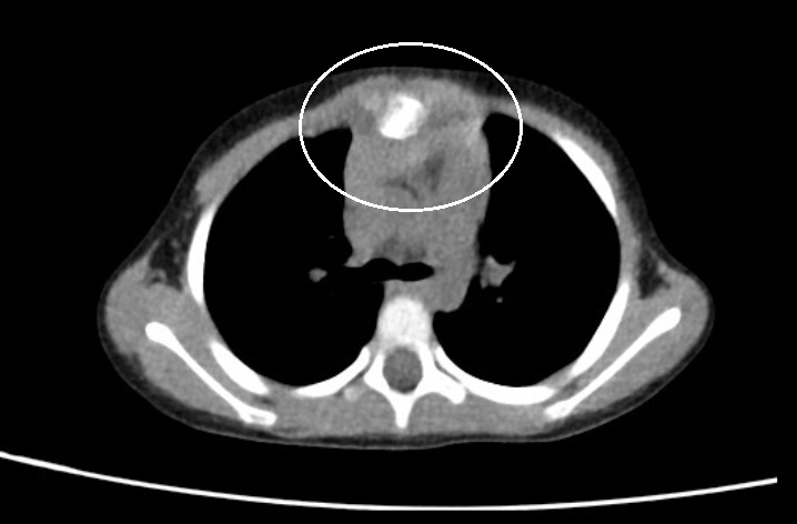 多发性肋骨骨折引发胸廓畸形矫正,股骨下端粉碎性骨折三维重建