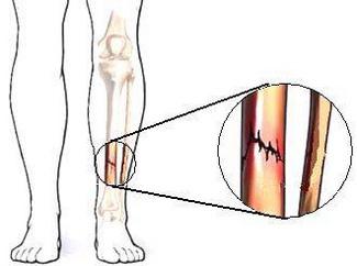 骨折和骨裂哪一个更严重,骨折与骨裂哪个严重