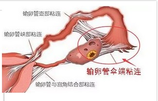 衣原体感染是炎症吗,衣原体感染白细胞和脓尿一样吗