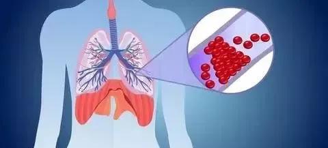 肺动脉主干堵塞命在旦夕，专家大胆溶栓终于脱险