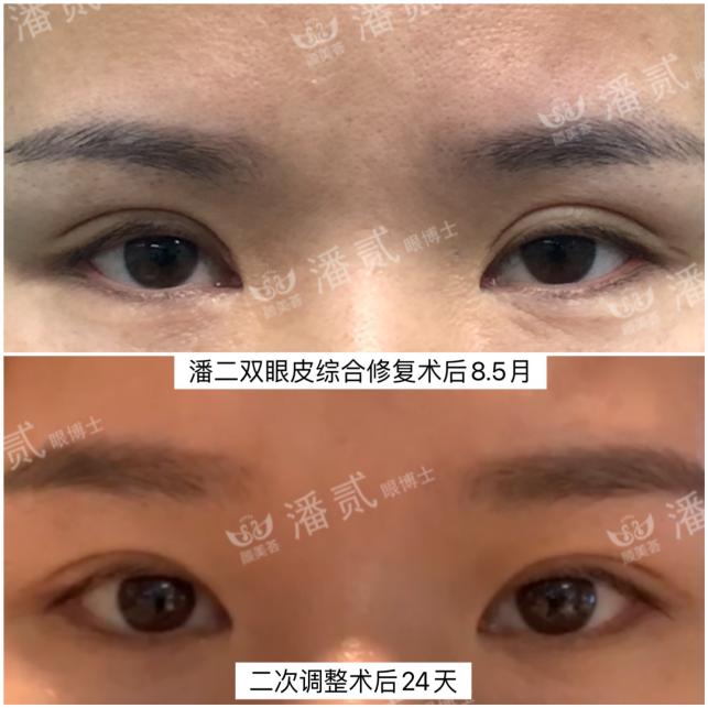 双眼皮太深显老怎么修复,双眼皮失败后修窄