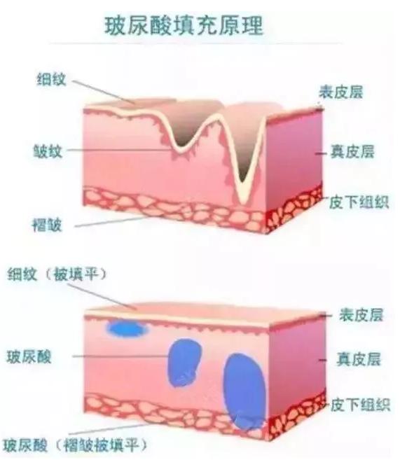 光子嫩肤脱毛仪的危害和禁忌,光子嫩肤注意事项文字
