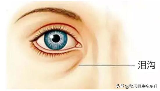 面部提拉可以改善泪沟嘛,做完面部提升手术