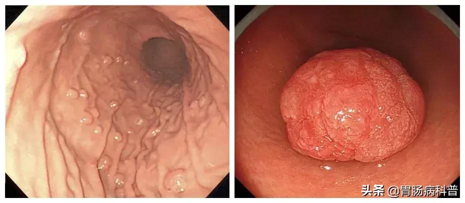 为什么胃息肉会癌变,如何判定胃息肉有没有癌变