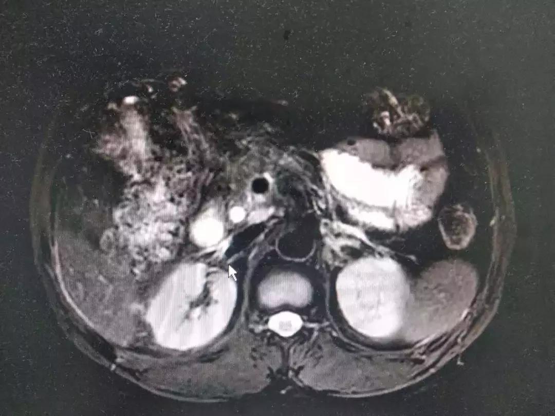 诊断梗阻性黄疸最有效的检查方法,梗阻性黄疸哪种引流方法好