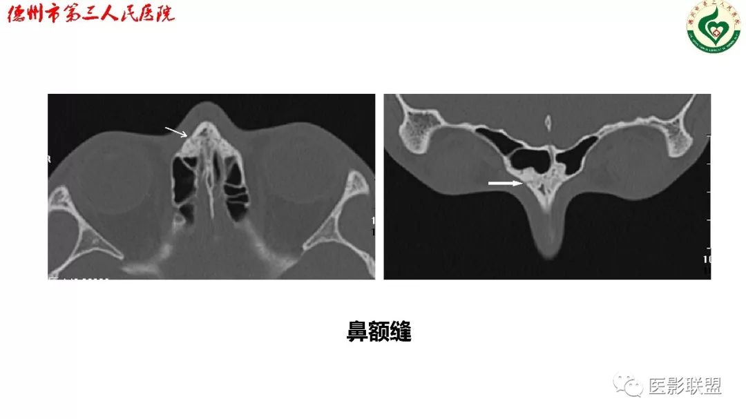 鼻骨骨折dr影像表现,鼻骨骨折影像学诊断