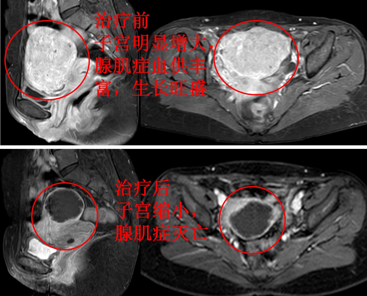 看看痛不欲生的子宫腺肌症痛经专业领域的看法与典型病例