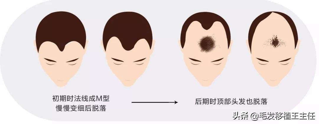 早期遗传性脱发就认命了吗,遗传性脱发是不是只能植发了