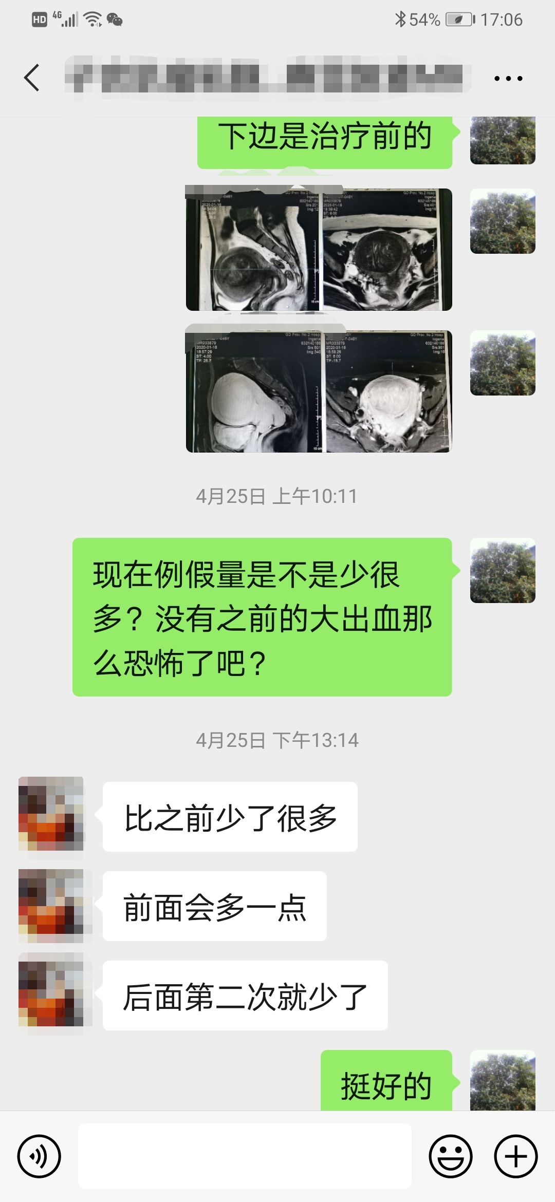 子宫肌瘤微创后月经量大有血块,严重贫血子宫肌瘤手术风险大不大