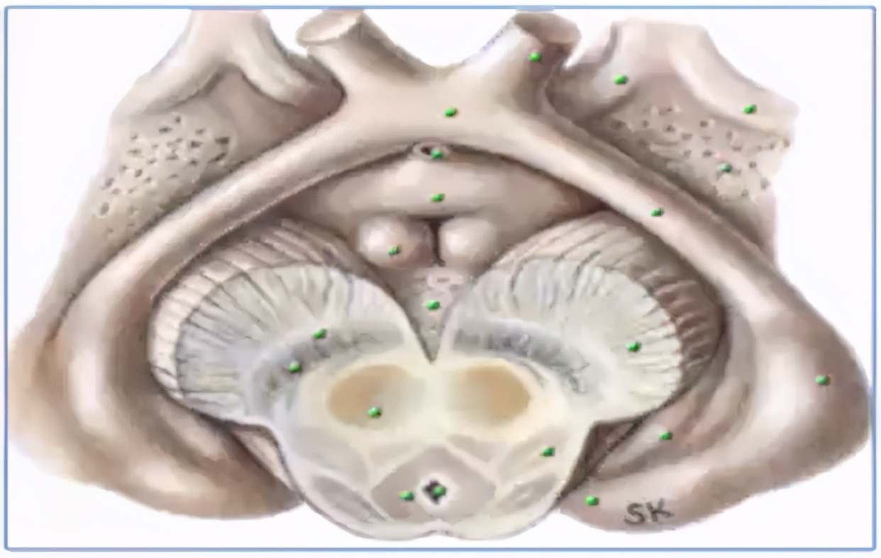 INC巴特朗菲教授视频|视神经-下丘脑胶质瘤全切案例集及治疗解读