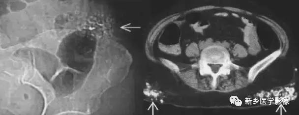 腹部平片可以看出肠胃疾病吗,腹部散在结节状高密度影