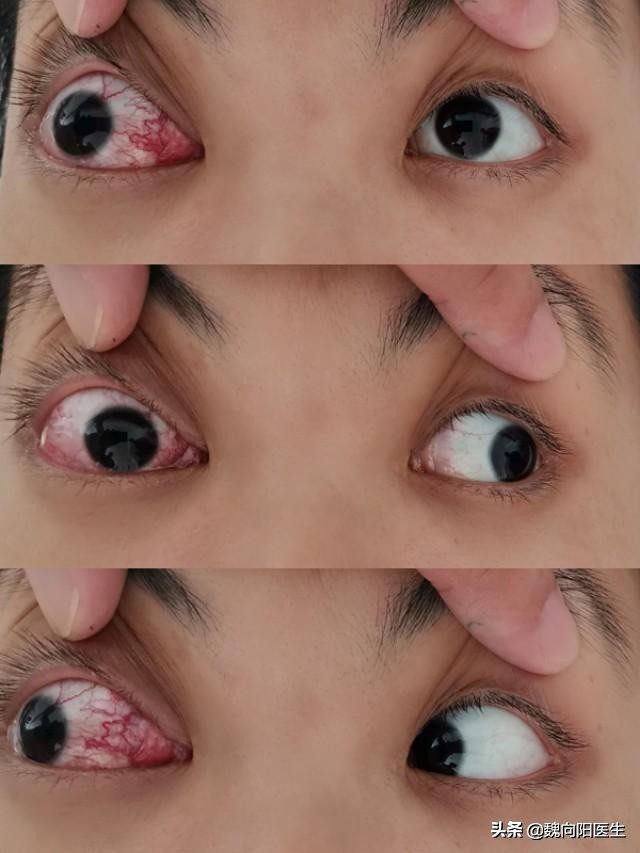 颈动脉海绵窦瘘症状,颈动脉海绵窦瘘介入需要多少钱