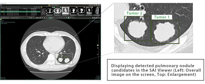 风湿结节的症状有哪些,风湿结节是什么症状