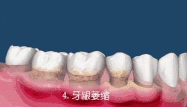 洗牙之后牙缝敏感,洗牙疼不疼