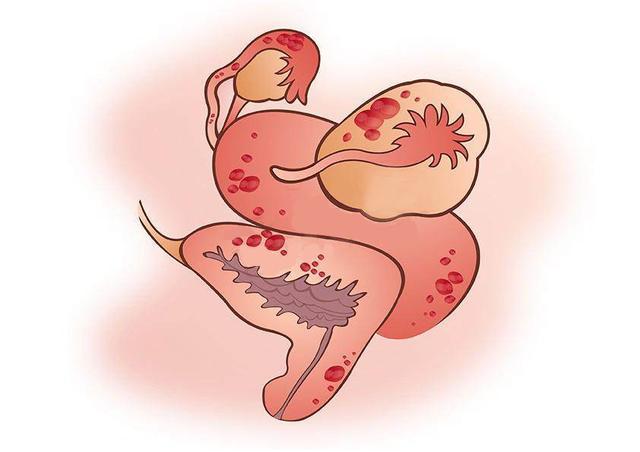 妇科医生：宫颈囊肿的症状有哪些？女性宫颈囊肿的危害有哪些？