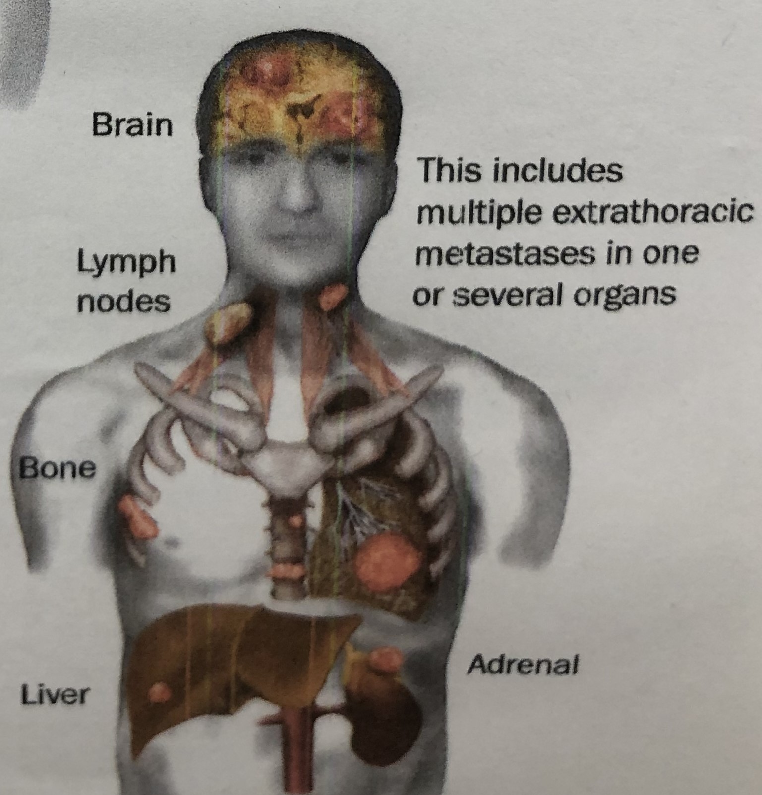 怎样判断非小细胞肺癌早中晚期,做气管镜能查出肺癌早中晚期吗